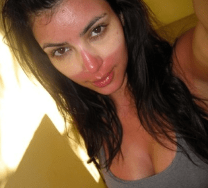 Kim K sunburn